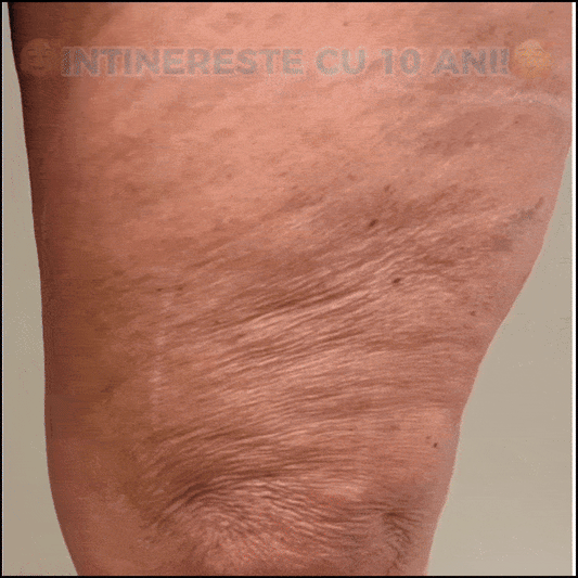 Ulei Pentru Fermitatea Si Elasticitatea Pielii